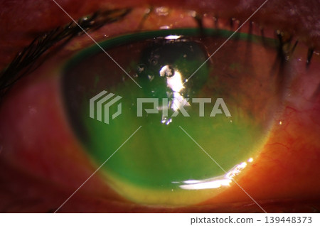 Anterior segment photography revealing corneal abrasion with positive fluorescein staining. Anterior segment photography revealing corneal abrasion with positive fluorescein staining. 139448373