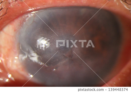 Central corneal abrasion and haze observed during ophthalmic examination. 139448374
