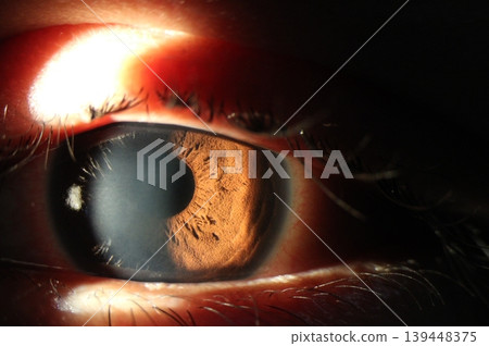 Clinical image showing corneal epithelial defect observed on eye examination. 139448375