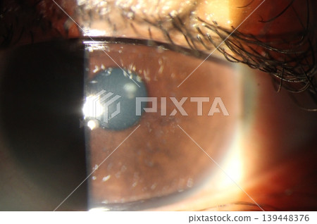 Close up of abrasion on the central corneal surface. 139448376