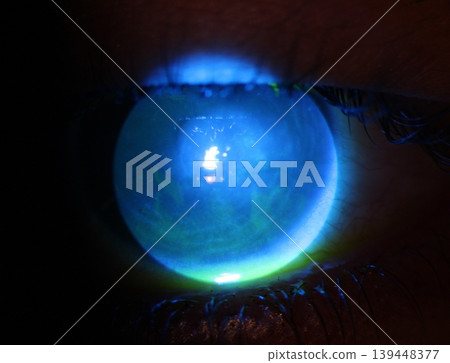 Close up of corneal abrasion during eye examination. 139448377