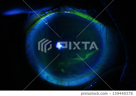 Close up of linear corneal abrasion during eye examination. 139448378