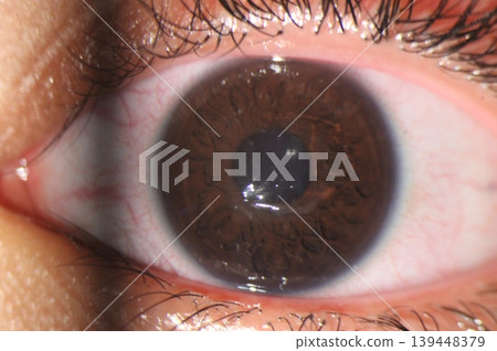 Close-up of a corneal epithelial abrasion during an eye examination. Close-up of a corneal epithelial abrasion during an eye examination. 139448379
