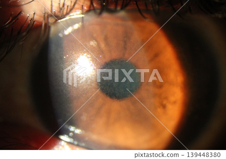 Close-up of a granular diffuse corneal abrasion observed during an eye examination. 139448380