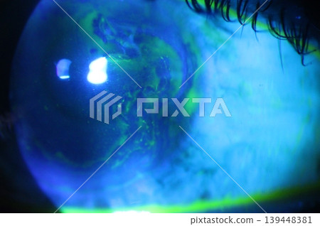 Close-up of a large diffuse corneal abrasion under cobalt blue illumination. 139448381