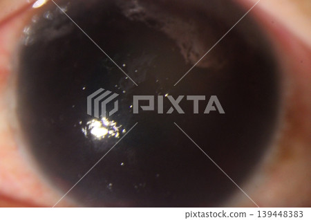 Close-up of central corneal epithelial disruption during an eye examination. Close-up of central corneal epithelial disruption during an eye examination. 139448383
