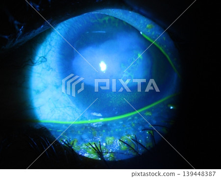 Close-up of punctate and round corneal abrasions during an eye examination. Close-up of punctate and round corneal abrasions during an eye examination. 139448387