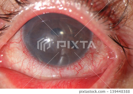 Anterior chamber intraocular lens with marked conjunctival hyperemia on eye examination. Anterior chamber intraocular lens with marked conjunctival hyperemia on eye examination. 139448388