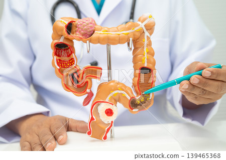 Colorectal cancer, doctor holding intestine colon human anatomy model. 139465368