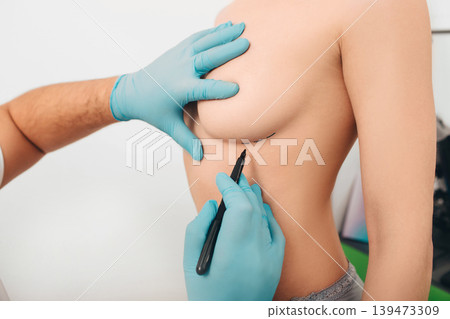 Plastic surgeon marks woman breast for installing breast silicone implant. Cosmetic breast surgery. 139473309