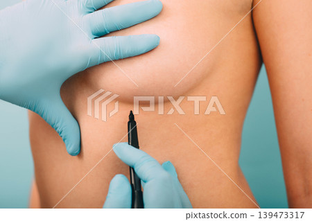 Plastic surgeon marks woman breast for installing breast silicone implant. Cosmetic breast surgery. Plastic surgeon marks woman breast for installing breast silicone implant. Cosmetic breast surgery. 139473317