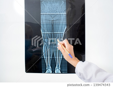 X-ray of knee joint on a negatoscope, X-ray as a type of diagnosis for the treatment of diseases and injuries of the joints of the legs 139474343