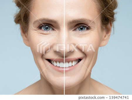 Woman's face before and after skin tightening and anti-aging procedures. Remove of wrinkles, nasolabial folds, skin rejuvenation procedure Woman's face before and after skin tightening and anti-aging procedures. Remove of wrinkles, nasolabial folds, skin rejuvenation procedure 139474741