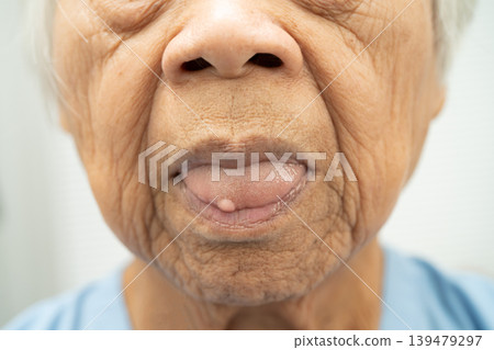 Cysts at the tongue in mouth of Asian elderly old lady woman patient. 139479297