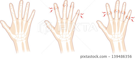 Normal fingers and bones of Heberden's nodes and Bouchard's nodes Normal fingers and bones of Heberden's nodes and Bouchard's nodes 139486356