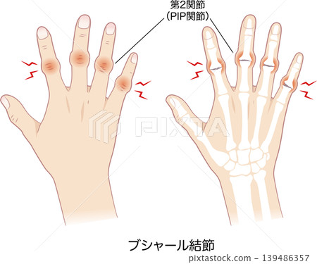 布沙爾結節的症狀、右手及其骨骼 布沙爾結節的症狀、右手及其骨骼 139486357