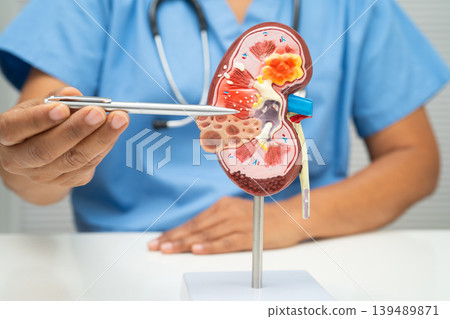 Chronic kidney disease, doctor with model for treatment urinary system, urology, Estimated glomerular filtration rate eGFR. Chronic kidney disease, doctor with model for treatment urinary system, urology, Estimated glomerular filtration rate eGFR. 139489871