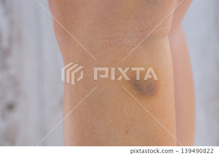 Unrecognized person with bruises on body at home scene. Close-up of woman with bruised leg. Bruising leg area, injury accident. Concept of home abuse. Consequences Unrecognized person with bruises on body at home scene. Close-up of woman with bruised leg. Bruising leg area, injury accident. Concept of home abuse. Consequences 139490822