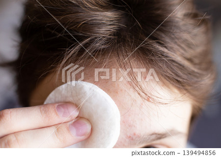 Forehead skin cleansing with cotton pad removing acne Forehead skin cleansing with cotton pad removing acne 139494856