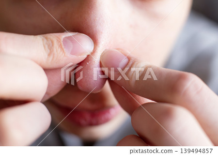Person squeezing blackheads from nose pore skin 139494857