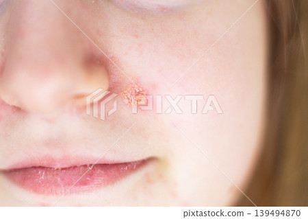 Child having impetigo skin infection chicken pox on face Child having impetigo skin infection chicken pox on face 139494870