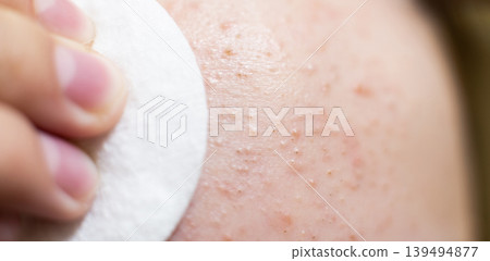 Forehead skin cleansing with cotton pad removing acne Forehead skin cleansing with cotton pad removing acne 139494877