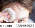 Forehead skin cleansing with cotton pad removing acne 139494924