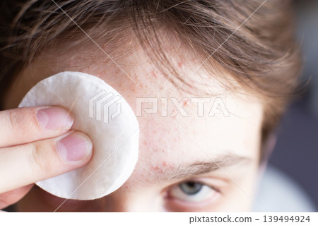 Forehead skin cleansing with cotton pad removing acne 139494924