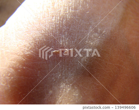 close-up of a crack in the skin of the hands close-up of a crack in the skin of the hands 139496606