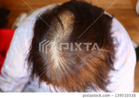 Scalp close-up and hair growth image of a Japanese woman suffering from thinning hair on the crown and gray hair. Scalp close-up and hair growth image of a Japanese woman suffering from thinning hair on the crown and gray hair. 139510338