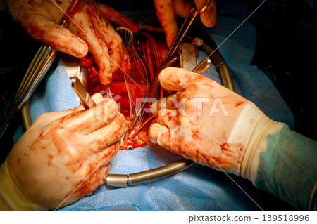 Surgeons perform operation on patient in hospital during major heart surgery Surgeons perform operation on patient in hospital during major heart surgery 139518996