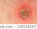 Close up of red skin lesion with crusting 139538167