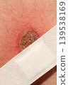 White medical plaster on inflamed skin area 139538169
