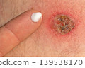 Applying medical cream to skin lesion 139538170