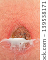 White ointment applied on red skin wound 139538171