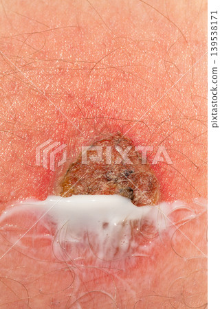 White ointment applied on red skin wound White ointment applied on red skin wound 139538171