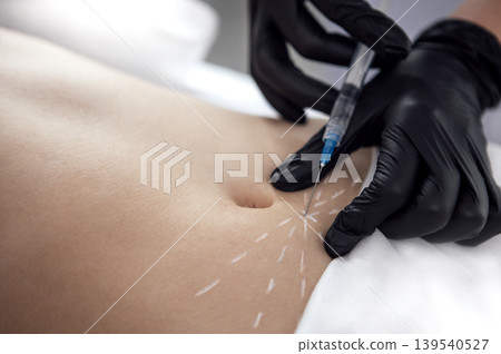 Female medical professional wearing black gloves is administering an injection on a patient's abdomen, showcasing a clinical environment with focus on precision and care in aesthetic treatment Female medical professional wearing black gloves is administering an injection on a patient's abdomen, showcasing a clinical environment with focus on precision and care in aesthetic treatment 139540527