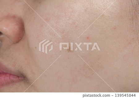 Asian woman with acne spot on facial skin before laser dermatology treatment. Pigmentation issue and skincare concern. Acne blemish and dark spot before laser skincare procedure in dermatology clinic. Asian woman with acne spot on facial skin before laser dermatology treatment. Pigmentation issue and skincare concern. Acne blemish and dark spot before laser skincare procedure in dermatology clinic. 139545844
