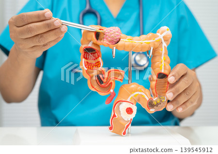Colorectal cancer, doctor holding intestine colon human model. 139545912