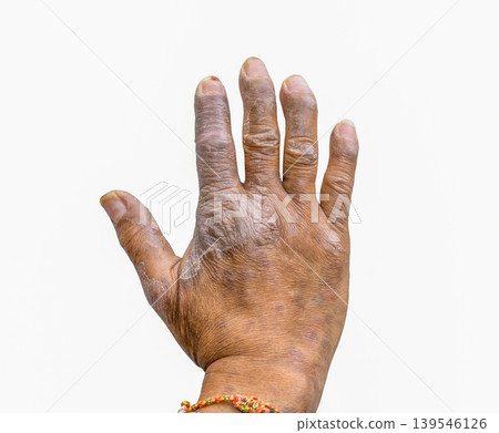 Psoriasis on farmer hand. Chronic dermatology skin disease with finger deformity. Occupational health risk, inflammation and need for medical treatment and care. Chronic autoimmune dermatology disease Psoriasis on farmer hand. Chronic dermatology skin disease with finger deformity. Occupational health risk, inflammation and need for medical treatment and care. Chronic autoimmune dermatology disease 139546126