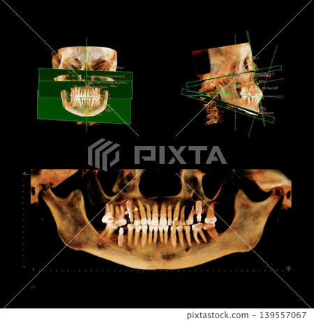 Computed tomography of adult female patient with Temporomandibular joint (TMJ, joint of lower jaw). Dental x-ray of an adult patient showing teeth, jaws and mandibular joint. Modern digital tomography Computed tomography of adult female patient with Temporomandibular joint (TMJ, joint of lower jaw). Dental x-ray of an adult patient showing teeth, jaws and mandibular joint. Modern digital tomography 139557067