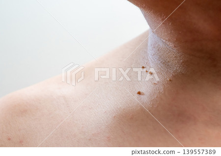 Close up detail of little skin tags or acrochordon at the neck of the man shot in a studio on white background. Close up detail of little skin tags or acrochordon at the neck of the man shot in a studio on white background. 139557389