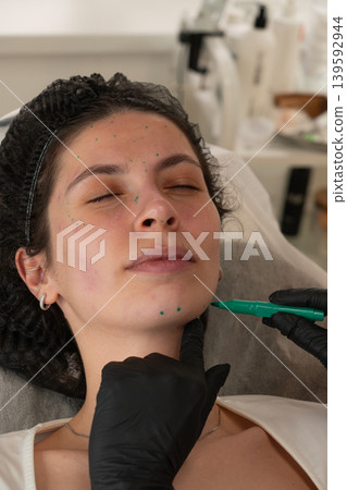 Facial Marking Before Cosmetic Injection Procedure Close Up 139592944