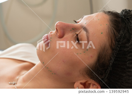 Facial Marking Before Cosmetic Injection Procedure Close Up 139592945