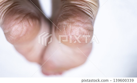 Dry skin on the feet, woman heel Dry skin on the feet, woman heel 139600339