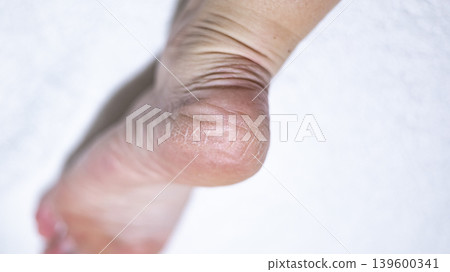 Dry skin on the feet, woman heel Dry skin on the feet, woman heel 139600341