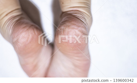 Dry skin on the feet, woman heel Dry skin on the feet, woman heel 139600342