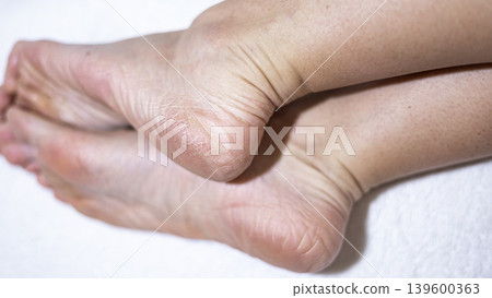 Dry skin on the feet, woman heel Dry skin on the feet, woman heel 139600363