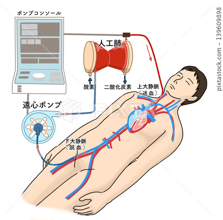 An illustration showing the structure of an ECMO (extracorporeal membrane oxygenation) device. 139609898