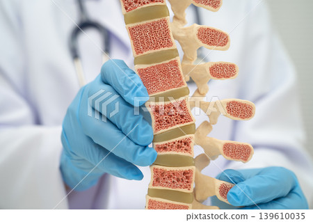 Doctor holding osteoporosis in back bone model. Doctor holding osteoporosis in back bone model. 139610035